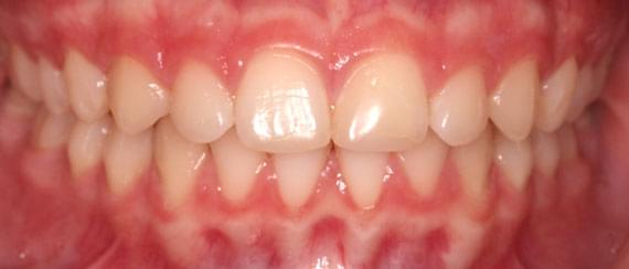 curvature AFTER myobrace 11 years