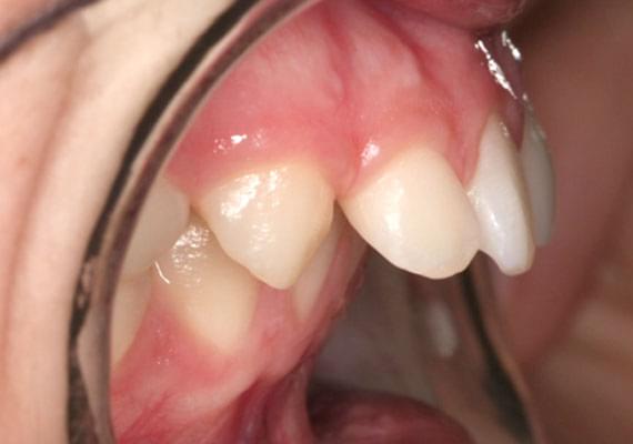 curvature BEFORE myobrace 11 years side