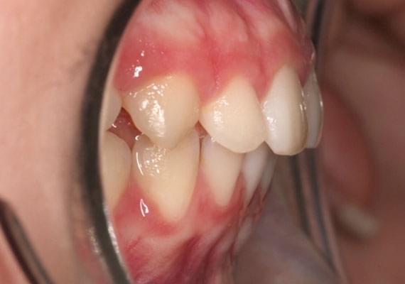 curvature AFTER myobrace 11 years side