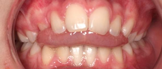 BEFORE myobrace 11 years