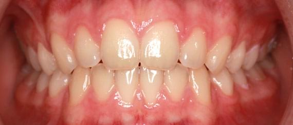 AFTER myobrace 11 years