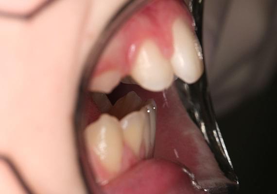 BEFORE myobrace 11 years side