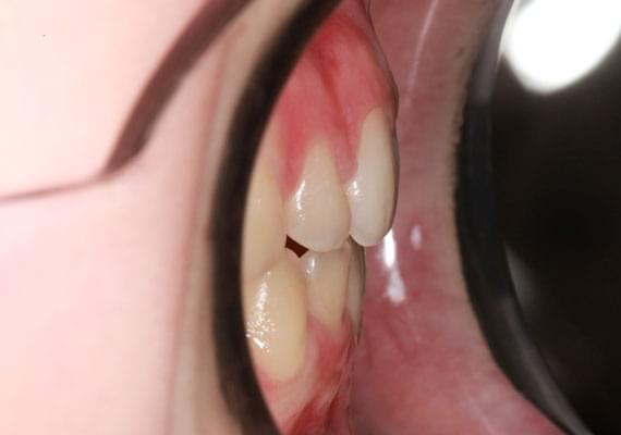 AFTER myobrace 11 years side