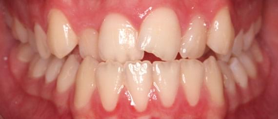 curvature of teeth 11 years