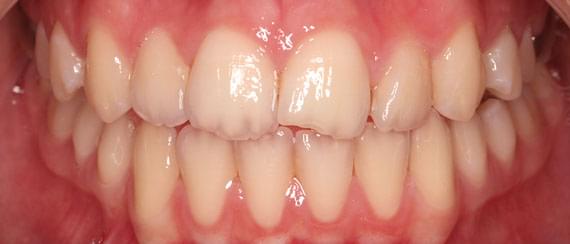 healthy teeth 11 years