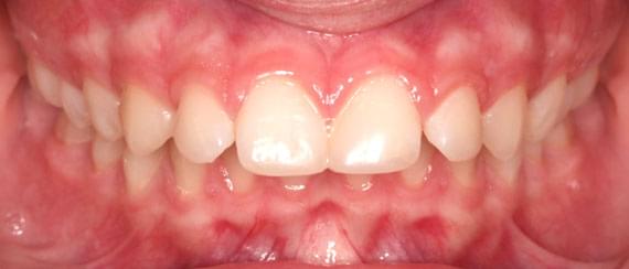 curvature BEFORE myobrace 11 years