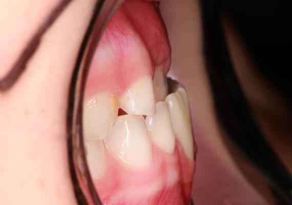 curvature BEFORE myobrace 7 years side