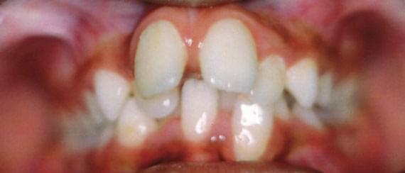 BEFORE myobrace 7 years