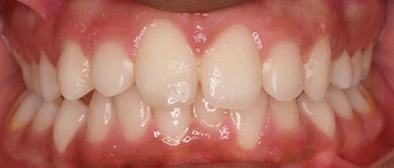 AFTER myobrace 7 years