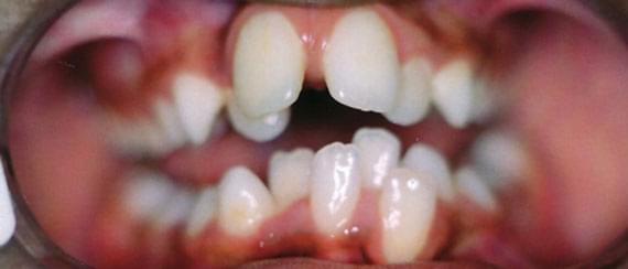 BEFORE myobrace 7 years side