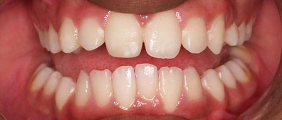 AFTER myobrace 7 years side