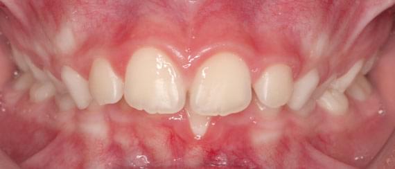 curvature of teeth 7 years