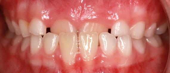 curvature BEFORE myobrace 7 years