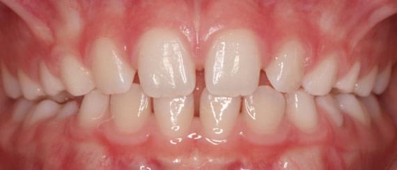 curvature AFTER myobrace 3-6 years