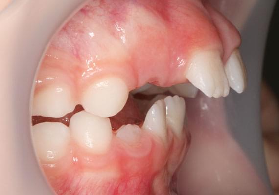 curvature BEFORE myobrace 3-6 years side