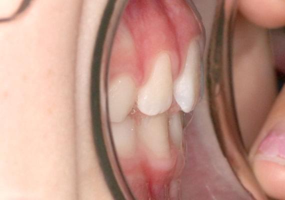 curvature AFTER myobrace 3-6 years side