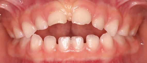 BEFORE myobrace 3-6 years