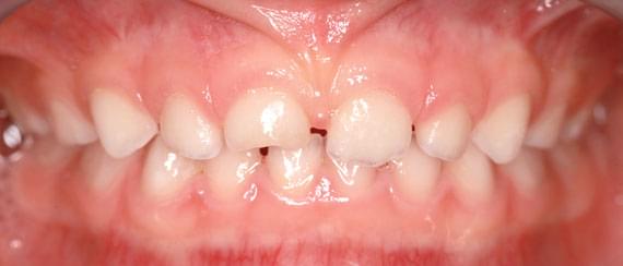 AFTER myobrace 3-6 years