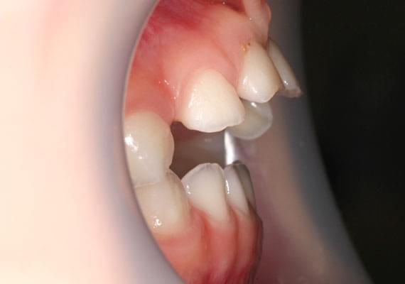 BEFORE myobrace 3-6 years side