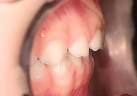 AFTER myobrace 3-6 years side