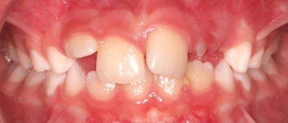 curvature of teeth 3-6 years