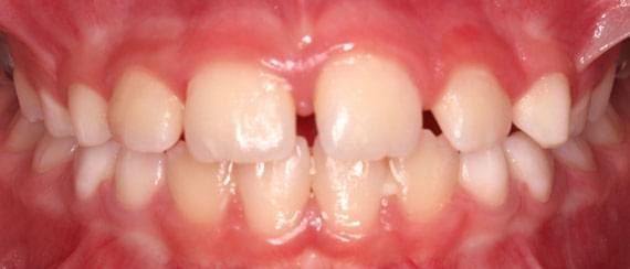 healthy teeth 3-6 years