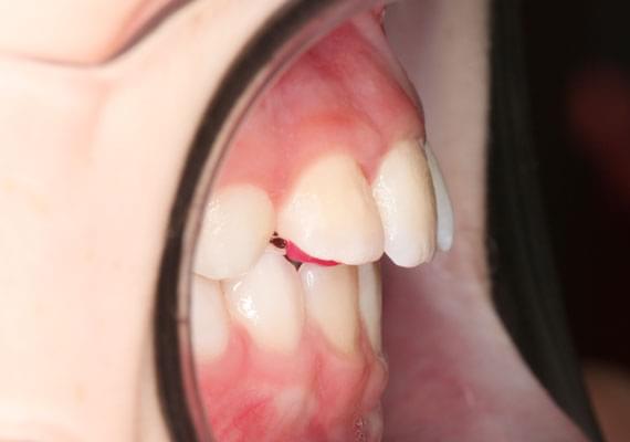 healthy teeth 3-6 years side