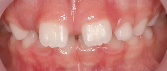 curvature BEFORE myobrace 3-6 years