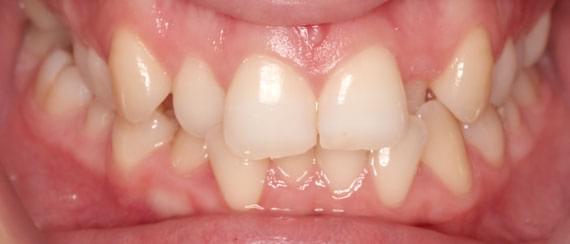 BEFORE myobrace 15 years