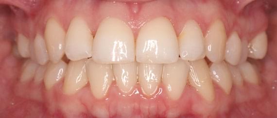 AFTER myobrace 15 years