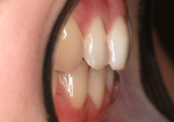 big curvature of teeth