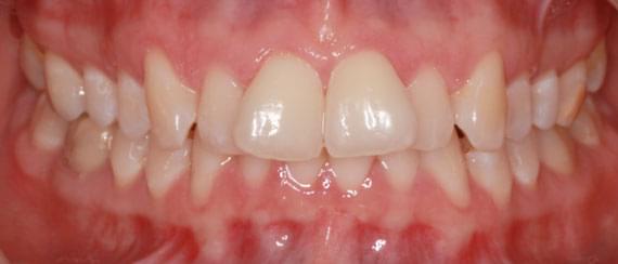 curvature BEFORE myobrace