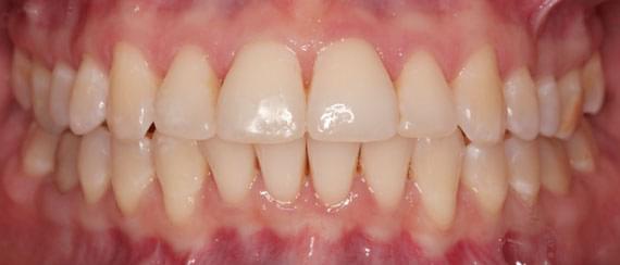 curvature AFTER myobrace